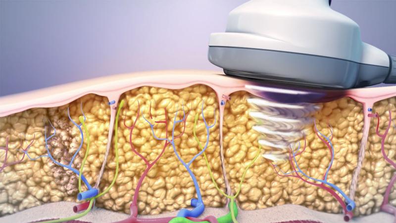 Photo Illustrating the Body Contouring Process from the UltraShape Device Photo illustrating the focus of the ultrasound energy delivered to tissue by the UltraShape Power Device.